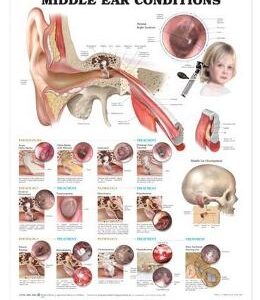 Middle Ear Conditions Anatomical Chart